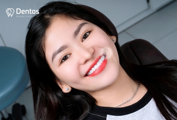 Gắn răng sứ là bước được mong chờ nhất tại Dentos.